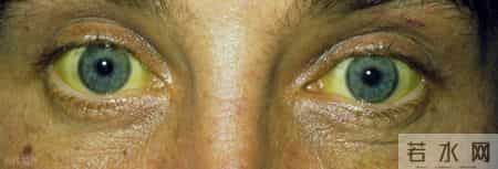 身体发出这5个“求救信号”，可能是消化系统肿瘤！