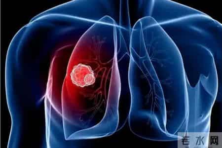 肺癌真凶找到了！医生提醒：不想被肺癌“带走”！3件事忽视不得