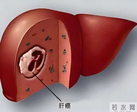 夫妻双双查出肝癌，肝胆科医生：排骨和它一起炖，简直是在服毒