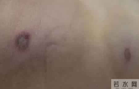 广西平南县一对夫妻遭马蜂袭击1死1伤，幸存者被换掉80%问题血液