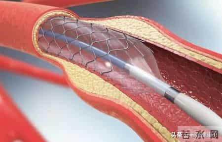 55岁大姐做完心脏支架，5年后复发走了，医生说：4点原因显而易见