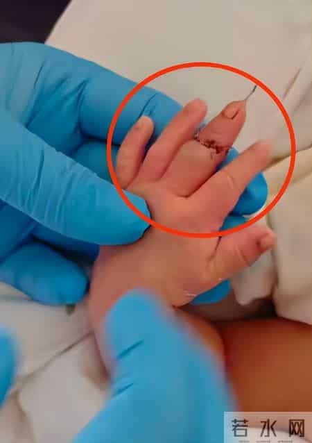 疼死了！新生儿被剪断手指紧急转院，暂不谈赔偿，家属发声太揪心