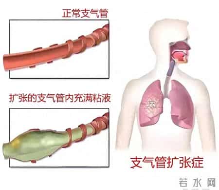 支气管扩张：一朵花，凉血宁络！巧用它，痰中带血不再怕！
