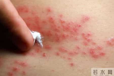 湿疹拖太久可能暗藏隐患，医生提醒：皮肤若出现这5种异常要警惕