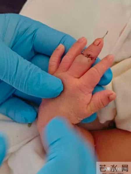 剪脐带剪到手指？1张新生儿“劫难图”，护士一句“乱动”想翻篇