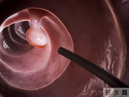 为什么很多人不愿做肠镜？院士：做一次肠镜，或能保你6年没问题