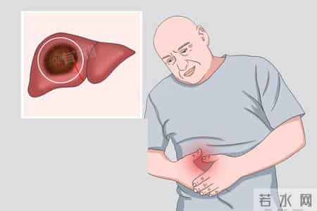 肝癌进展 5 个预警信号！忠告：出现一个就就医，别错过干预时机