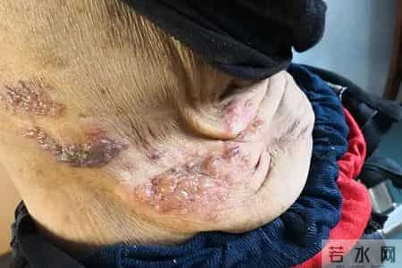 人不会平白无故患带状疱疹？医生：患带状疱疹，或有5个隐藏原因