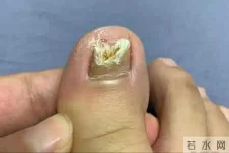 一旦腿部出现5个讯号，或说明血管已经开始堵塞，留意别不当回事