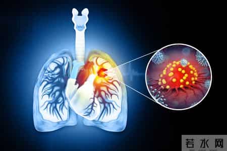 肺癌真凶找到了！医生提醒：不想被肺癌“带走”！3件事忽视不得