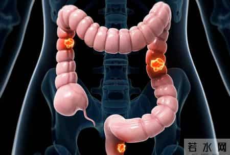 为什么很多人不愿做肠镜？医生：做一次肠镜，或能保你3年没问题