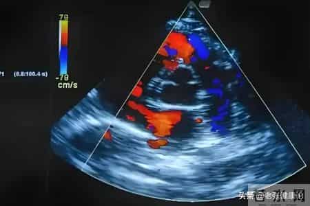 55岁大姐做完心脏支架，5年后复发走了，医生说：4点原因显而易见