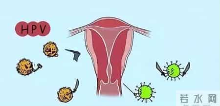 HPV阳性先别慌，千年古方一味药，提高抵抗力