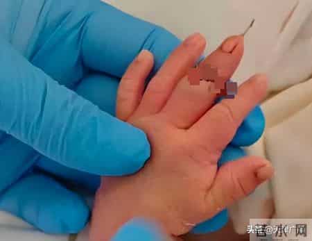 快评 - 新生儿手指被当成脐带剪断！只是助产士的问题？