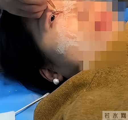贵州贵阳一女子用502胶水贴指甲片，不慎把眼睛、鼻子粘住，当事人表示：非常痛苦，有严重的濒死感