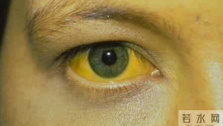 肝癌复发前身体会求救！主任提醒：报告中有这3种异常=警报拉响！