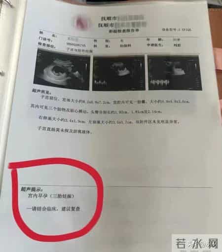 同卵四胞胎，每次产检多一个，她能保下几个