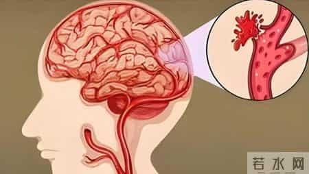 男子因脑梗不幸死亡！提醒：天冷宁愿在家打牌，也别干这些事！