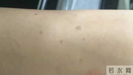 脸上、手背冒出的“小疙瘩”是啥？商丘专家详解扁平疣的防与治