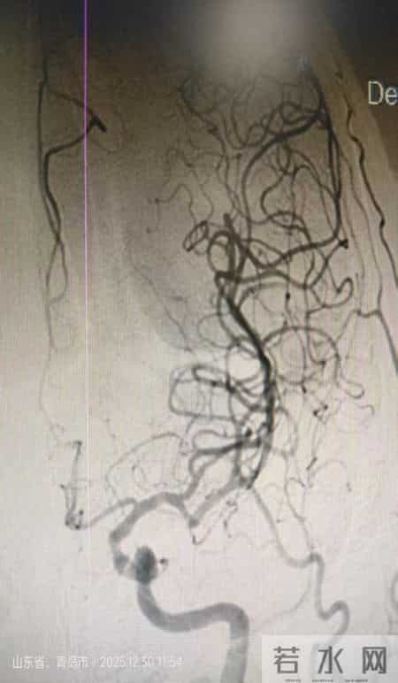平度市第三医院神经内科力挽狂澜，成功抢救2名大脑中动脉急性闭塞患者