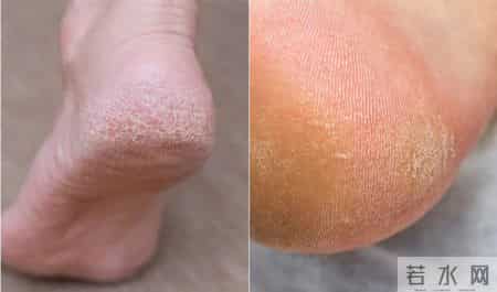 脚后跟干裂别硬扛，可能是身体在报警