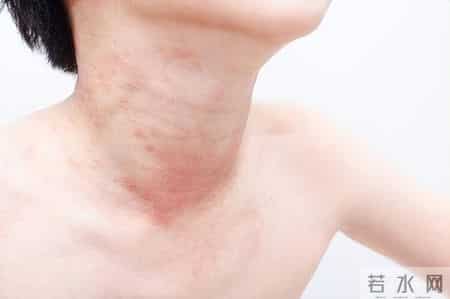 梅毒治愈后会复发吗？医生提醒：这2个习惯易诱发