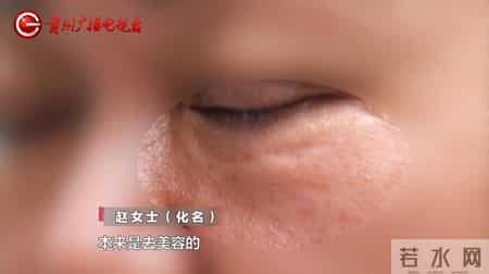 贵阳女子割眼袋遭灼伤，留疤五年未修复，整形医院突然撂挑子！面对记者质疑，经理扬言：还制约不了你们？