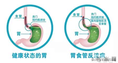 反流性食管炎防治指南：从检查、治疗到预防，一文掌握