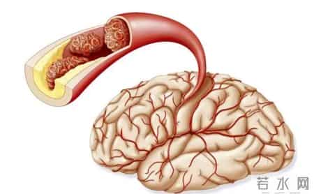 一66岁大妈喜欢睡前泡脚，不久脑梗去世，医生怒斥：太无知了
