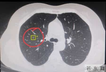 刘懿博士说肺癌（一〇六七〇）肺磨玻璃结节不大要切肺很多要慎重