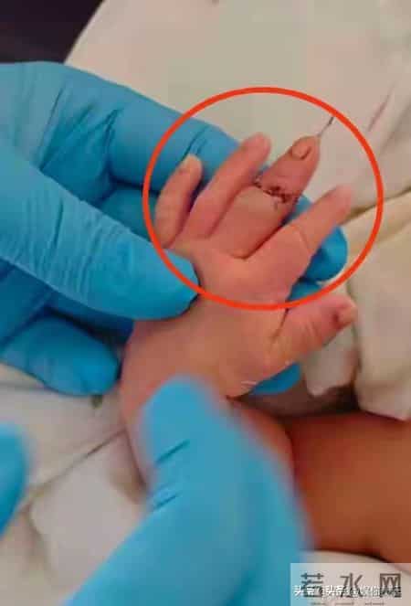 太离谱，手指被当脐带剪断！新生儿脸涨红哭得撕心裂肺，好心疼