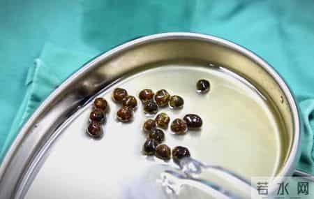 医生发现：天天揉腹的胆囊炎患者，用不了多久，身体会有3个改善