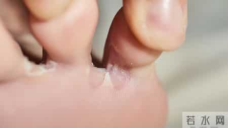 脚气总是反反复复？医生提醒：若发现脚气，日常谨记“3做4不做”