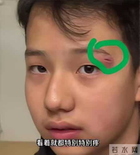 关凌为子挤痘缝4针！真心劝各位家长，别再瞎动手了