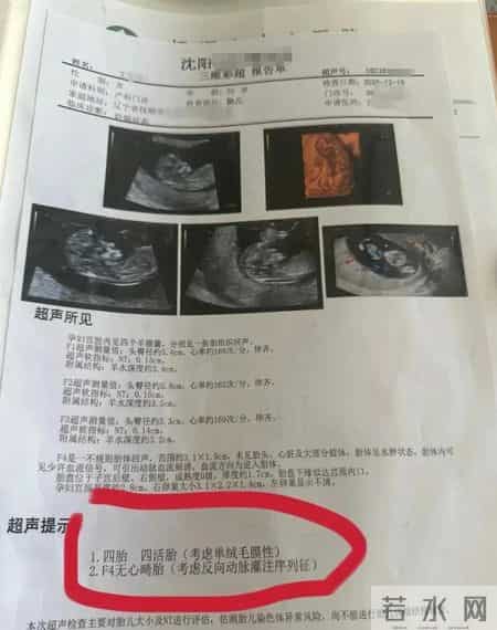 孕妇两个月内从一胎变四胞胎，每次产检都多出一胎！医生：系同卵四胞胎，概率1300万至1500万分之一！