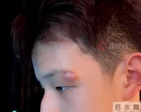 明星育儿“翻车”事件，挤痘痘真的会“要命”吗