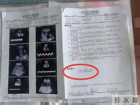 1300万分之一！抚顺孕妈怀同卵四胞胎，第四胎无心靠三胎供血