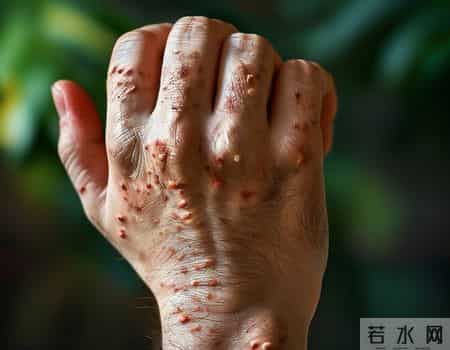 专家分析500名梅毒患者，发现感染梅毒的人，有5大特点