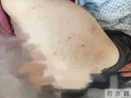 “像被火烧、被刀割”！台州九旬阿婆得了“不死癌症”，日夜受折磨