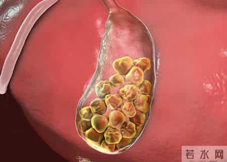 医生提醒：6种食物多吃容易长结石，中老年人再爱吃都要管住嘴