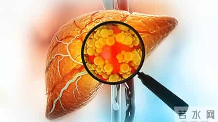 调查发现：67岁后常吃鸡蛋，患脂肪肝风险是不吃鸡蛋的数倍？