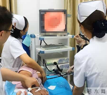 为啥很多人不愿意做肠镜？外国研究：做一次肠镜，或保十年安全？