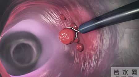 自2026年起，体检发现肠息肉的患者，千万重视做好这5项准备