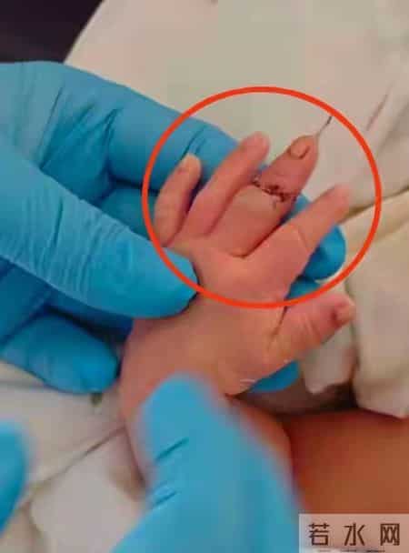 新生儿被剪断手指后续：父亲哭诉娃疼醒夜闹，孩子手未来功能成疑