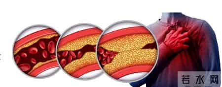 55岁男子冠脉狭窄85%，2年后却完全消失，他的3个方法，值得借鉴