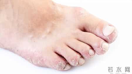 脚气总是反反复复？医生提醒：若发现脚气，日常谨记“3做4不做”