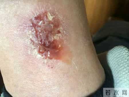 湿疹拖太久可能暗藏隐患，医生提醒：皮肤若出现这5种异常要警惕