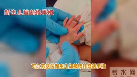揪心！新生儿断指插钢针日夜哭，手术成功却遭罪，家长崩溃了