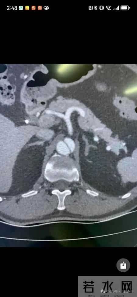 患者自述椎间盘犯了，住院后猝死，检查已做，报告未出，谁之责？
