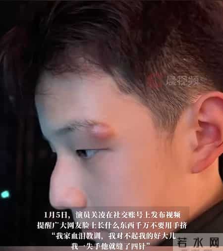 关凌为子挤痘缝4针！真心劝各位家长，别再瞎动手了